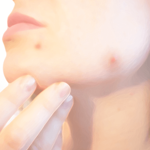 にきび・ニキビ跡